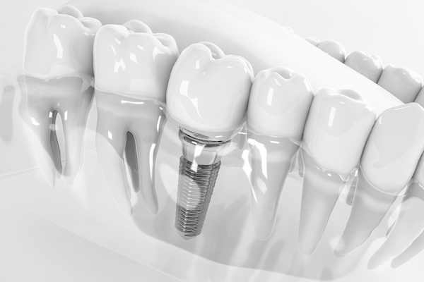 dental implants cabramatta