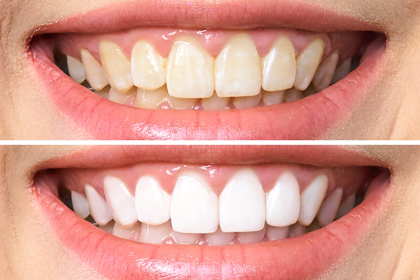 teeth whitening cabramatta