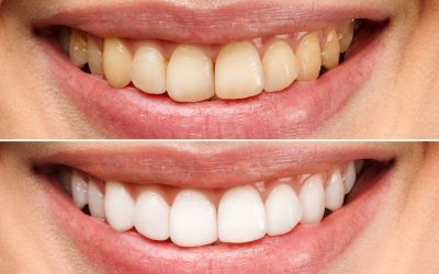 The Popularity of Teeth Whitening