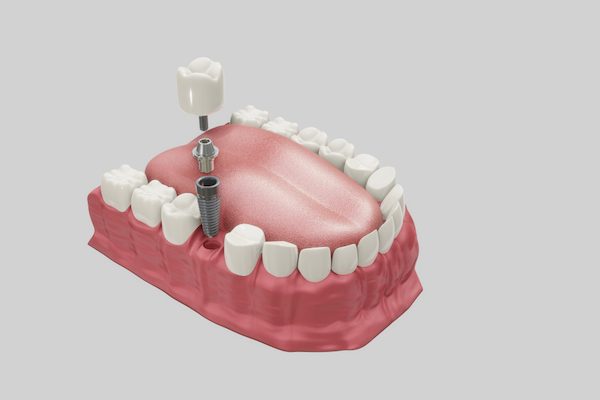 types of dental implants cabramatta