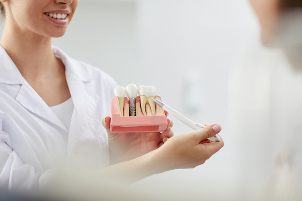 what are the advantages of dental implants cabramatta