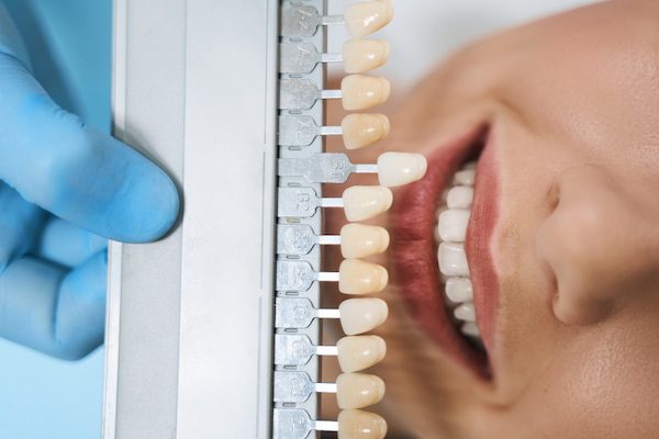 dental veneers blurb cabramatta