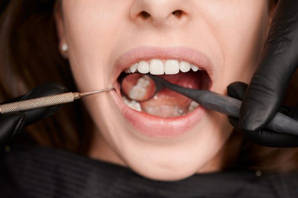 causes of broken tooth cabramatta
