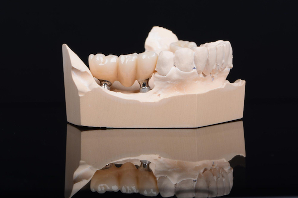 lost dental restorations cabramatta