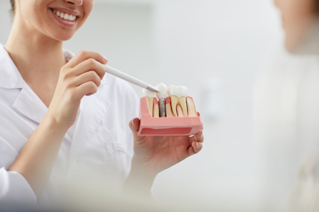 dental implants how long do they last dentist cabramatta