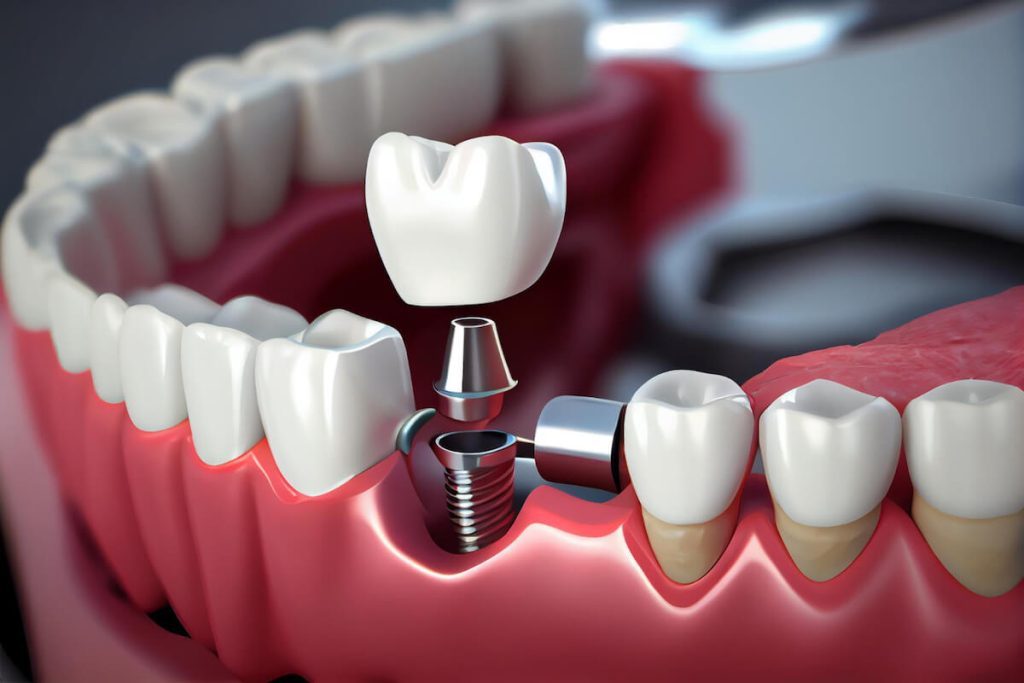 living with dental implants cabramatta dental care