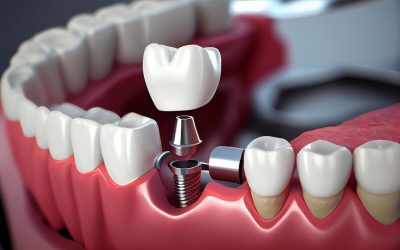 Living with Dental Implants: What to Expect